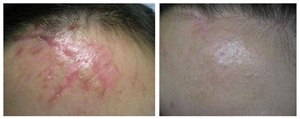 Лазерное удаление шрамов (фото: до и после)