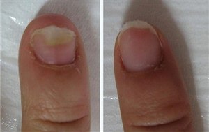 Лечение грибка ногтей на руках (фото: до и после)