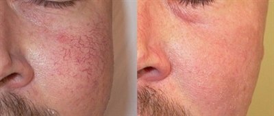 Лазерное удаление сосудов на лице (фото: до и после)