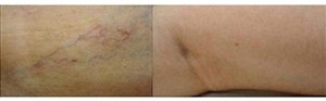 Удаление лазером "сосудистых звездочек" на ногах (фото: до и после)