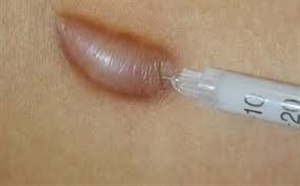 Внутриочаговые инъекции кортикостероидов для удаления шрамов