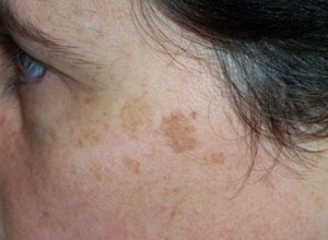 Себорейный кератоз