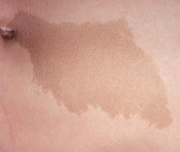 Пятна «Кофе с молоком»