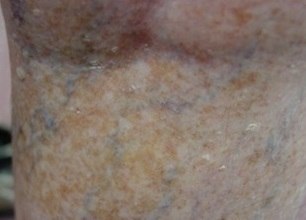 Гемосидероз