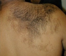 Невус Беккера