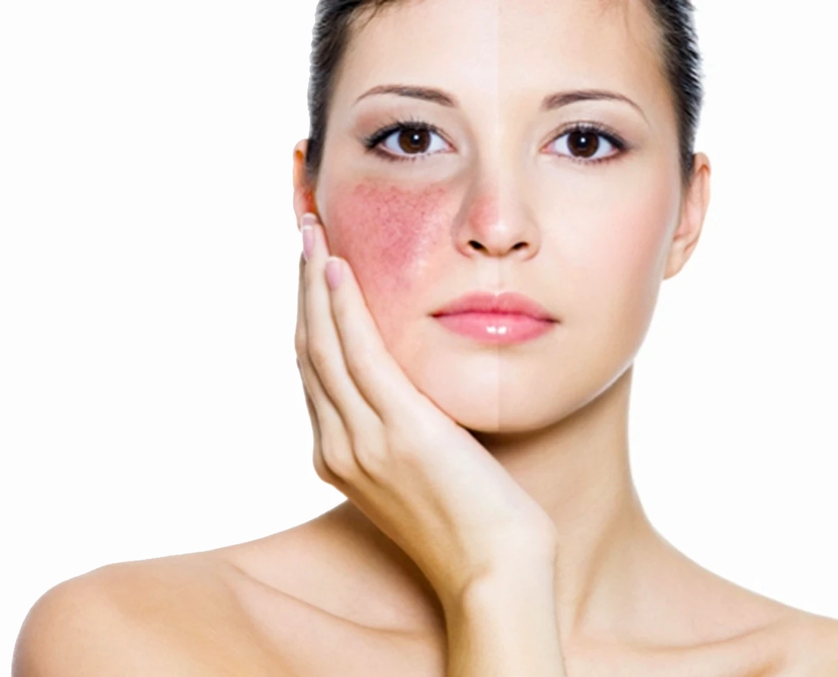 Удаление сосудистых звездочек