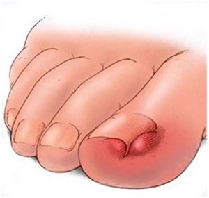 Лечение вросшего ногтя