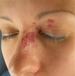 Капиллярная гемангиома