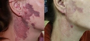 Удаление гемангиомы лазером (фото: до и после)