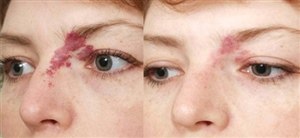 Удаление гемангиомы лазером (фото: до и после)