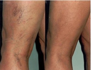 Удаление лазером "сосудистых звездочек" на ногах (фото: до и после)