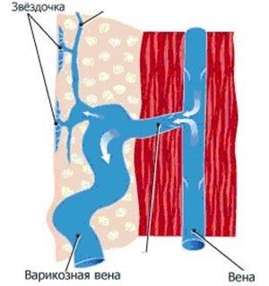 "Сосудистые звездочки" на ногах: причины возниконвения