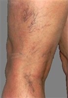 "Сосудистые звездочки" на ногах (варикоз)