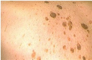 Себорейные кератомы