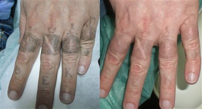 Лазерное удаление татуировок (фото: до и после)