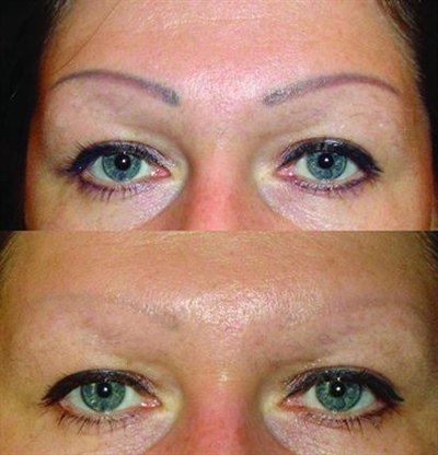 Удаление татуажа бровей (фото: до и после)