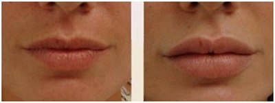 Гиалуроновая кислота: фото