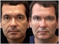 Объемное моделирование лица гиалуроновыми филлерами Ювидерм Волюма