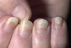 Грибок ногтей (онихомикоз)