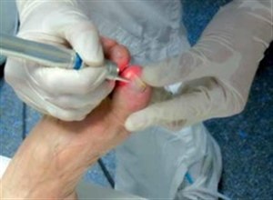 Лазерное лечение грибка ногтей