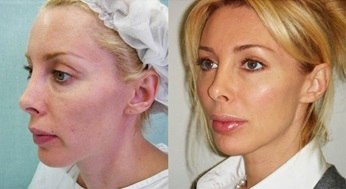 Нитевой лифтинг – фото