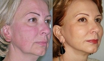 Нитевой лифтинг – фото