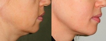 Нитевой лифтинг – фото