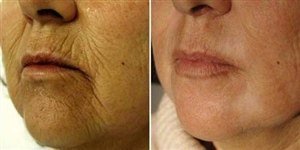 Микронидлинг - фото: до и после