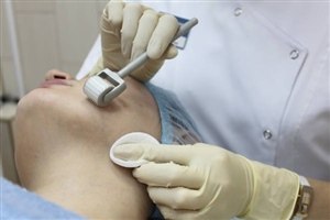 Микронидлинг - фото