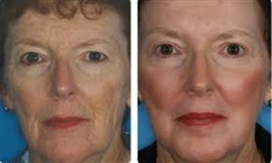 Срединный пилинг - результаты до и после