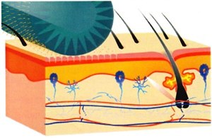 Дермароллер (микронидлинг) для коррекции атрофических рубцов
