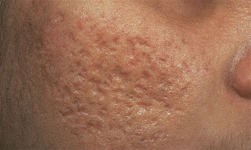 Коррекция атрофических рубцов