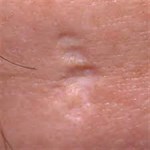 Коррекция атрофических рубцов