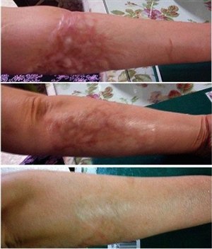 Дермароллер для удаления гипертрофических шрамов