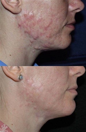 Химический пилинг для удаления шрамов