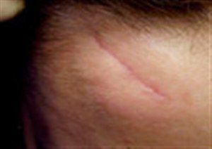 Субцизия для коррекции атрофических рубцов