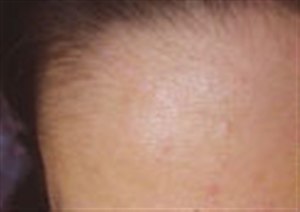 Субцизия для коррекции атрофических рубцов - результат