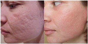 Дермароллер для коррекции атрофических рубцов - результат