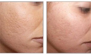 Химический пилинг для коррекции атрофических рубцов - результат