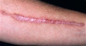 Как убрать гипертрофические шрамы