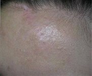 Удаление гипертрофических шрамов лазером - результат