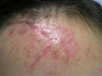 Удаление гипертрофических рубцов лазером