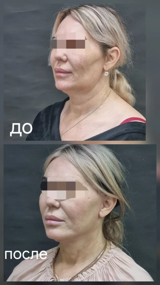 Короткорубцовая подтяжка: результаты