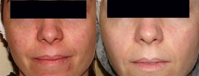 Фотоомоложение (фото: до и после)