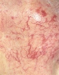 Сосудистые звездочки (телеангиэктазии)