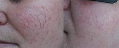 Лазерное удаление сосудов на лице (фото: до и после)