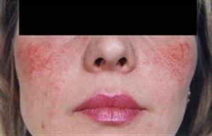 Сосудистые звездочки на лице