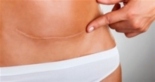 Коррекция рубцовых поражений кожи