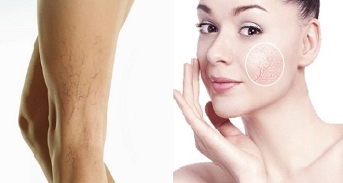 Лазерное удаление нежелательных сосудов