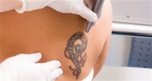 Удаление татуировок